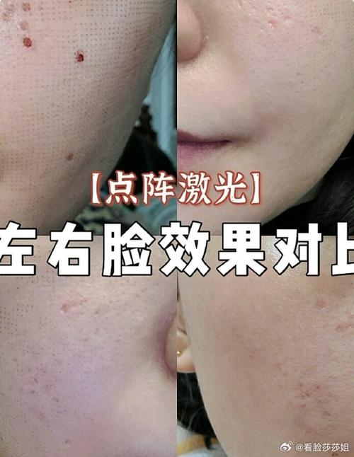 做点阵激光的危害