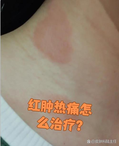 炎症低热和肿瘤低热