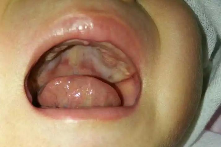婴儿鹅口疮症状图片