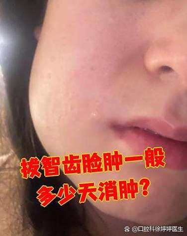 坏牙脸肿了一般几天恢复正常缩略图