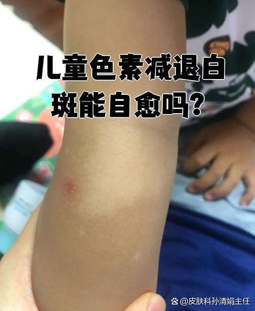 白白癜风病初期白点图片