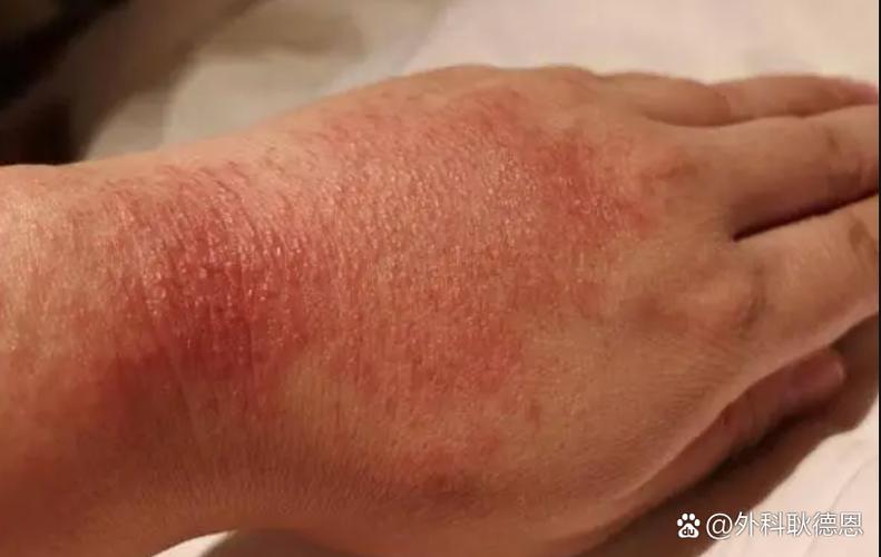 手臂上有红色斑块怎么回事