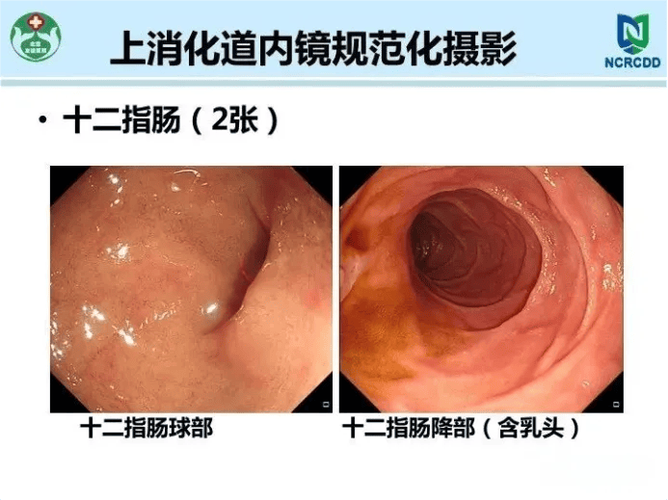 12指肠球部是指哪个部位缩略图
