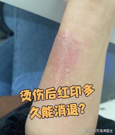 烫伤红印去除小妙招