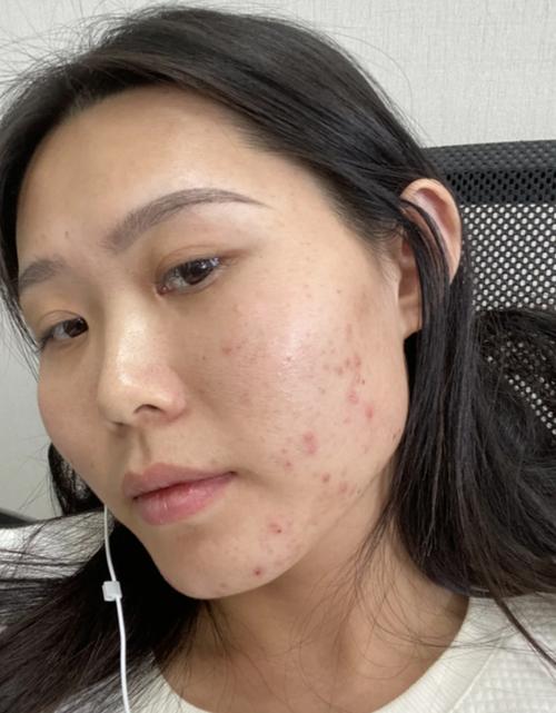 做完小气泡脸上狂爆痘