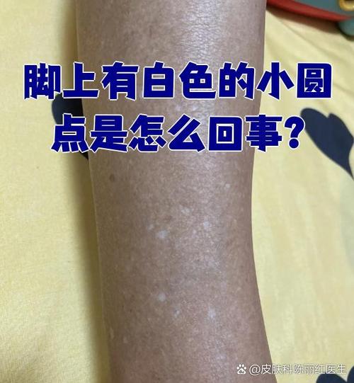脚上出现白斑图片