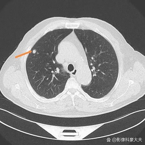 正常人肺部有结节吗