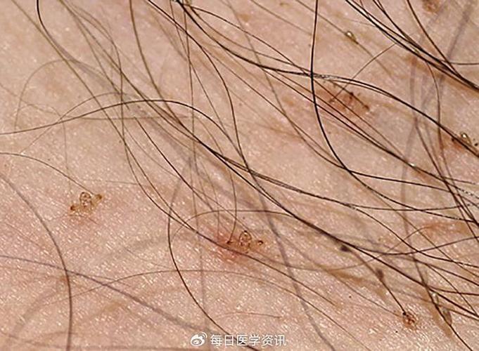 阴虱怎么彻底去除最简单的方法