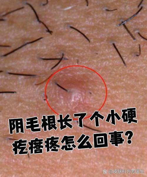 男性毛毛那边长了个疙瘩咋回事