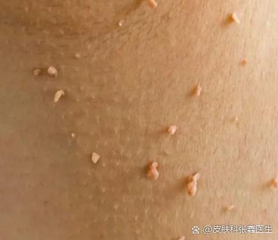 hpv病毒感染的症状缩略图