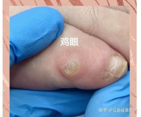 瘊子自己在家怎么去掉