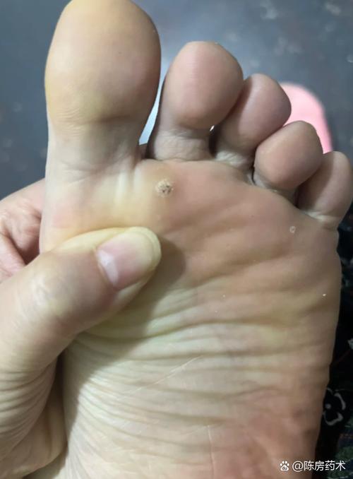 脚病毒疣