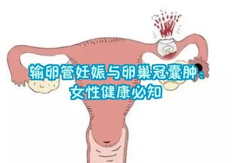 少了一个输卵管的危害