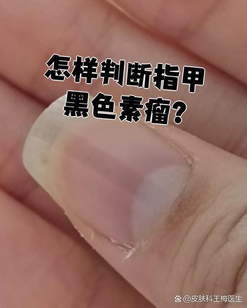 手指黑色素纹和黑素瘤的区别