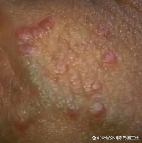 jb上面长小痘痘怎么办
