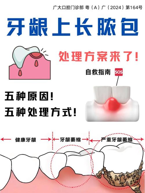 牙龈脓包最快消除方法