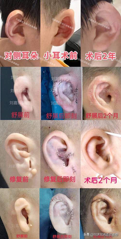 小耳畸形手术全部费用