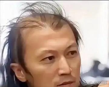 秃顶十几年了能治吗