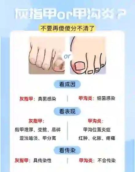 治甲沟炎的最好办法