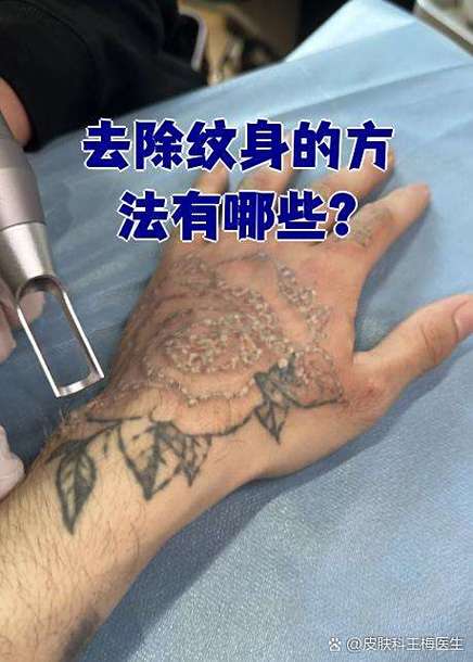 去医院洗纹身多少钱缩略图