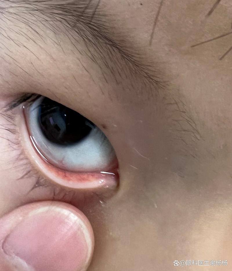泪点闭锁的症状