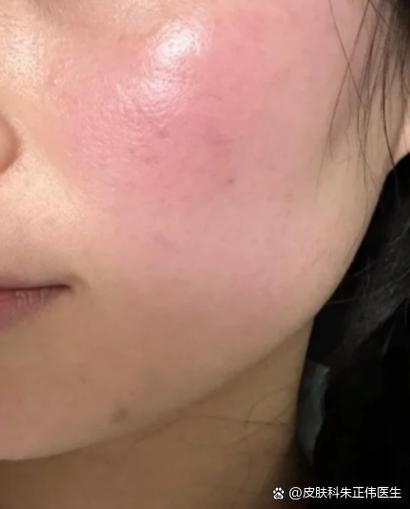 一热脸就发红怎么解决