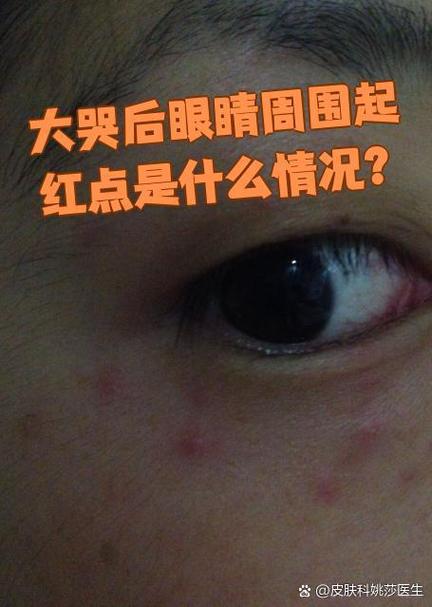 哭完后眼睛周围红斑是怎么回事