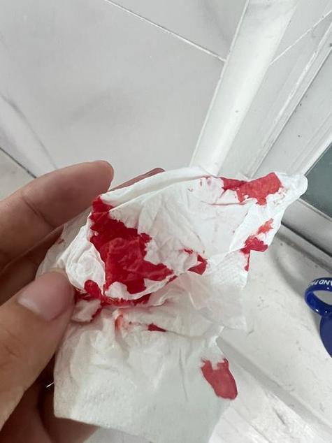 突然流鼻血很多像水一样