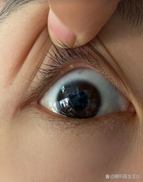 眼睛看到白色闪光点
