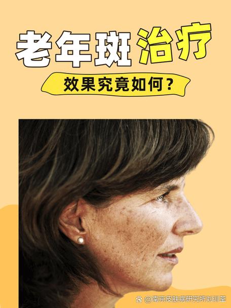 激光一颗老年斑多少钱