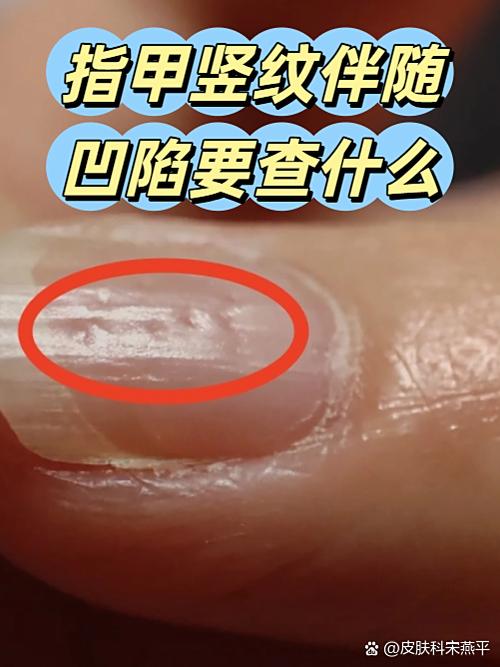 左脚大脚指甲有暗灰色竖线
