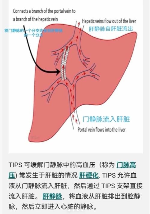 tips手术能做吗