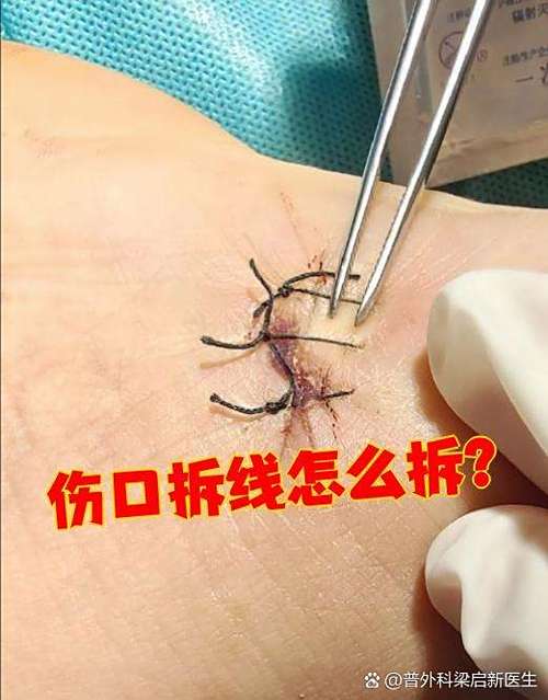 缝了三针可以自己拆线吗