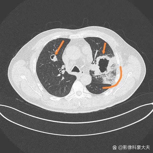 肺癌占位性的病变是晚期吗