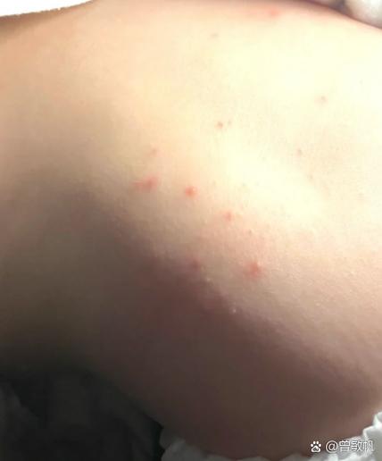 后腰痒痒越抓越痒怎么解决