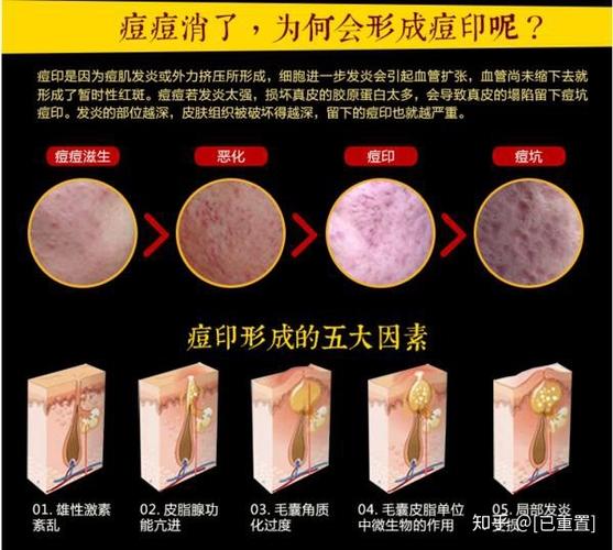 怎么消痘印