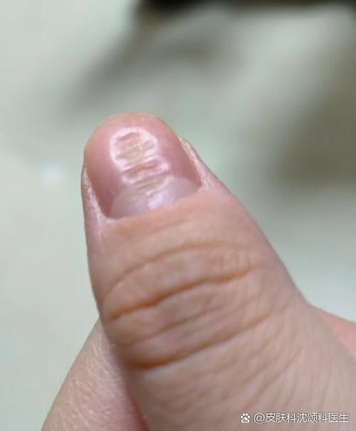 指甲突然出现横条纹