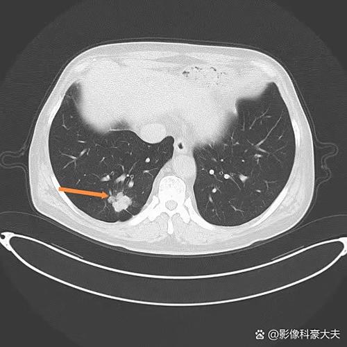肺结节有什么症状或前兆