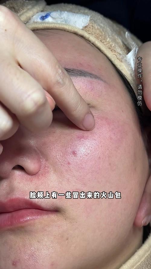 脸上起了好多红包怎么办缩略图