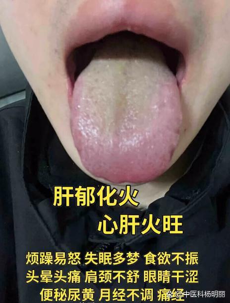 肝火旺会不会流鼻血