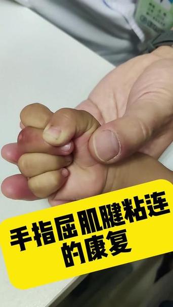 甲沟炎的治疗方法截图