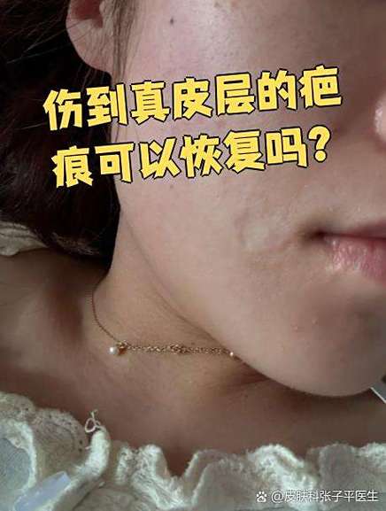 伤到真皮层的疤痕可以恢复么