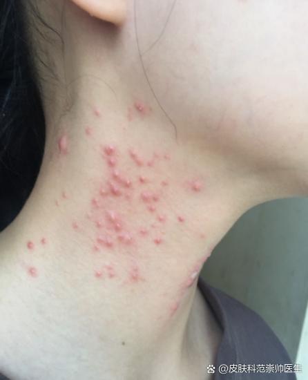 脖子出痘痘是啥原因