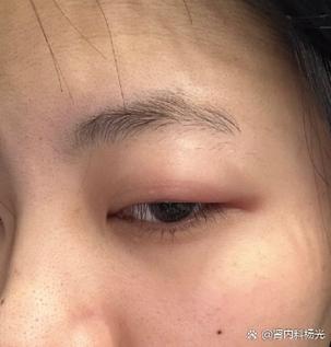 如何消除肿眼皮的方法