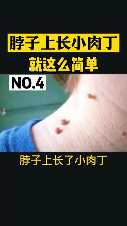 长肉丁怎么消除