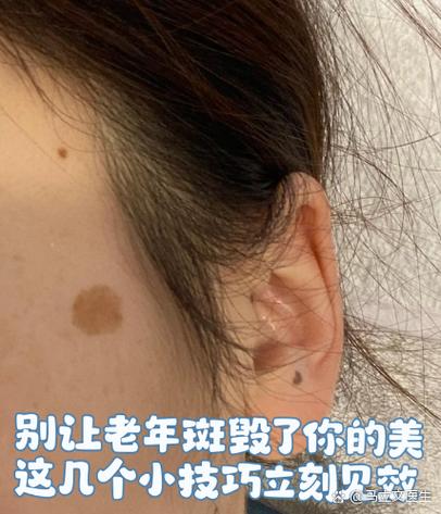 脸上有斑怎么去除