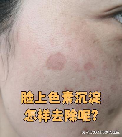 面部色素沉着怎么改善