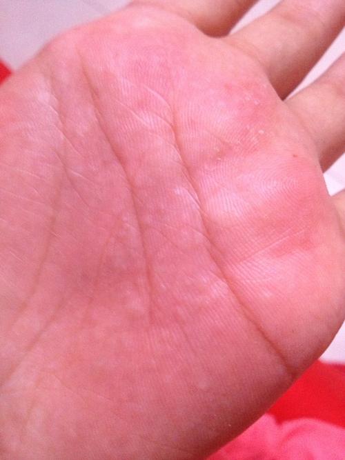 手心起了好多小疙瘩