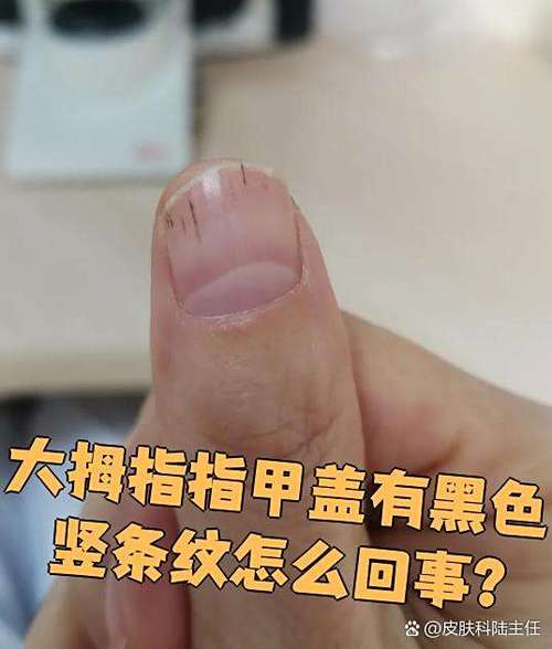 大拇指指甲有竖纹黑线