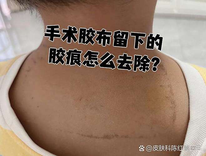 去除皮肤上的胶布痕迹